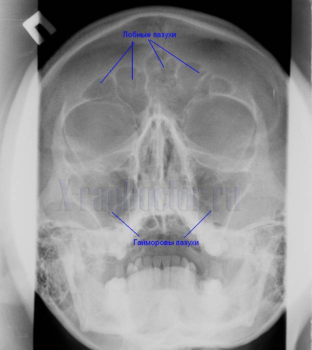 рентгенограмма придаточных пазух носа